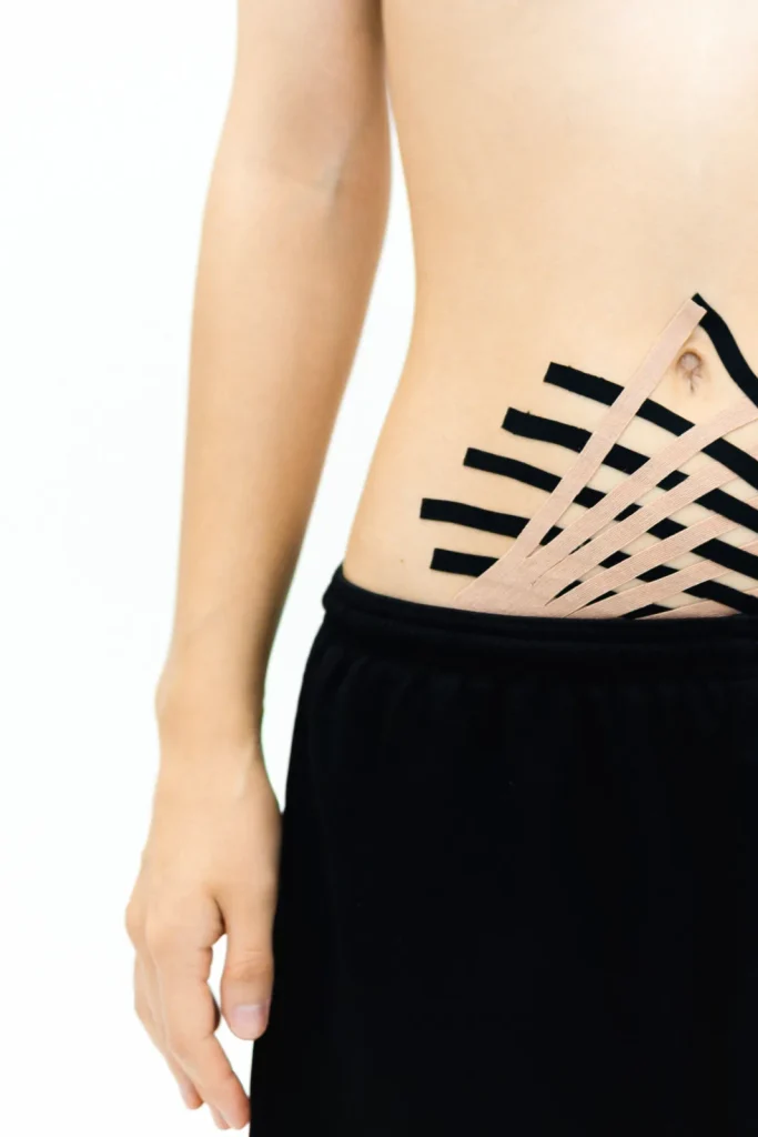 Aplicación de vendaje neuromuscular sobre la pared abdominal
